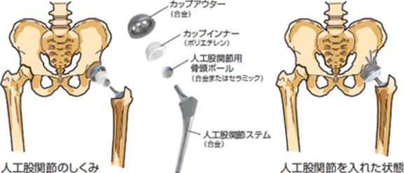 人工股関節の仕組み