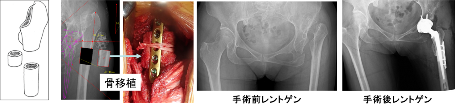 高位脱臼性股関節症に対する大腿骨短縮骨切りを併用した人工股関節 レントゲン