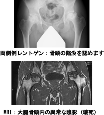 特発性大腿骨頭壊死症