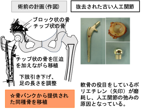 寛骨臼回転骨切り術