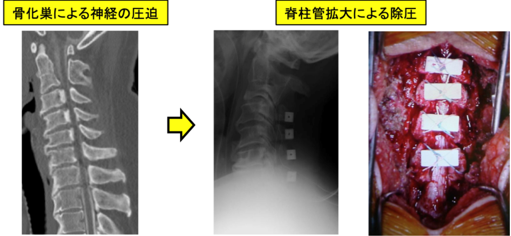 頚椎後縦靭帯骨化症