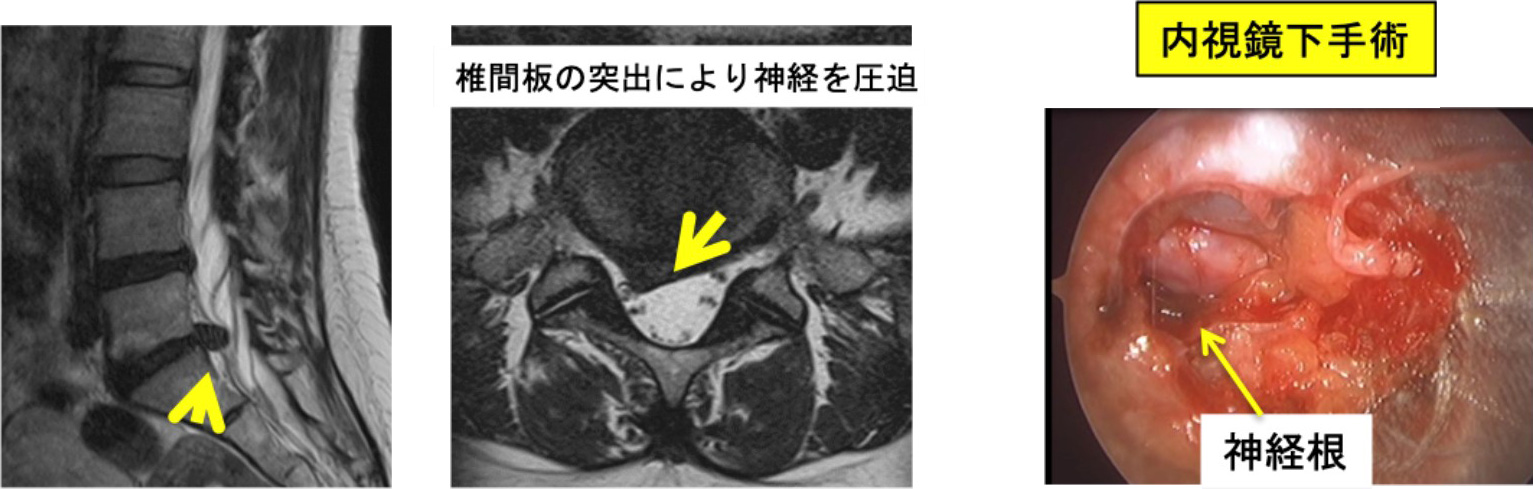 腰椎椎間板ヘルニア