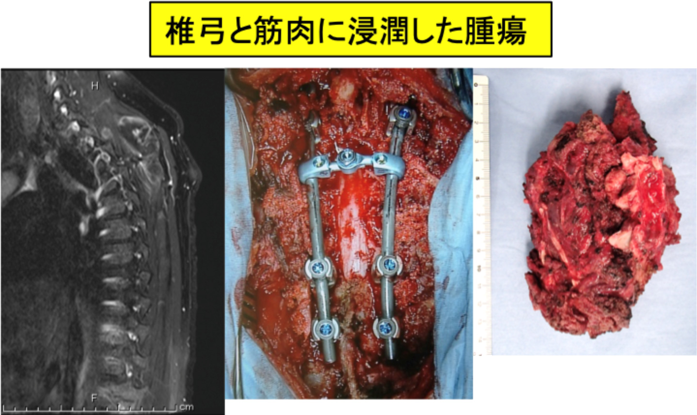 脊椎腫瘍