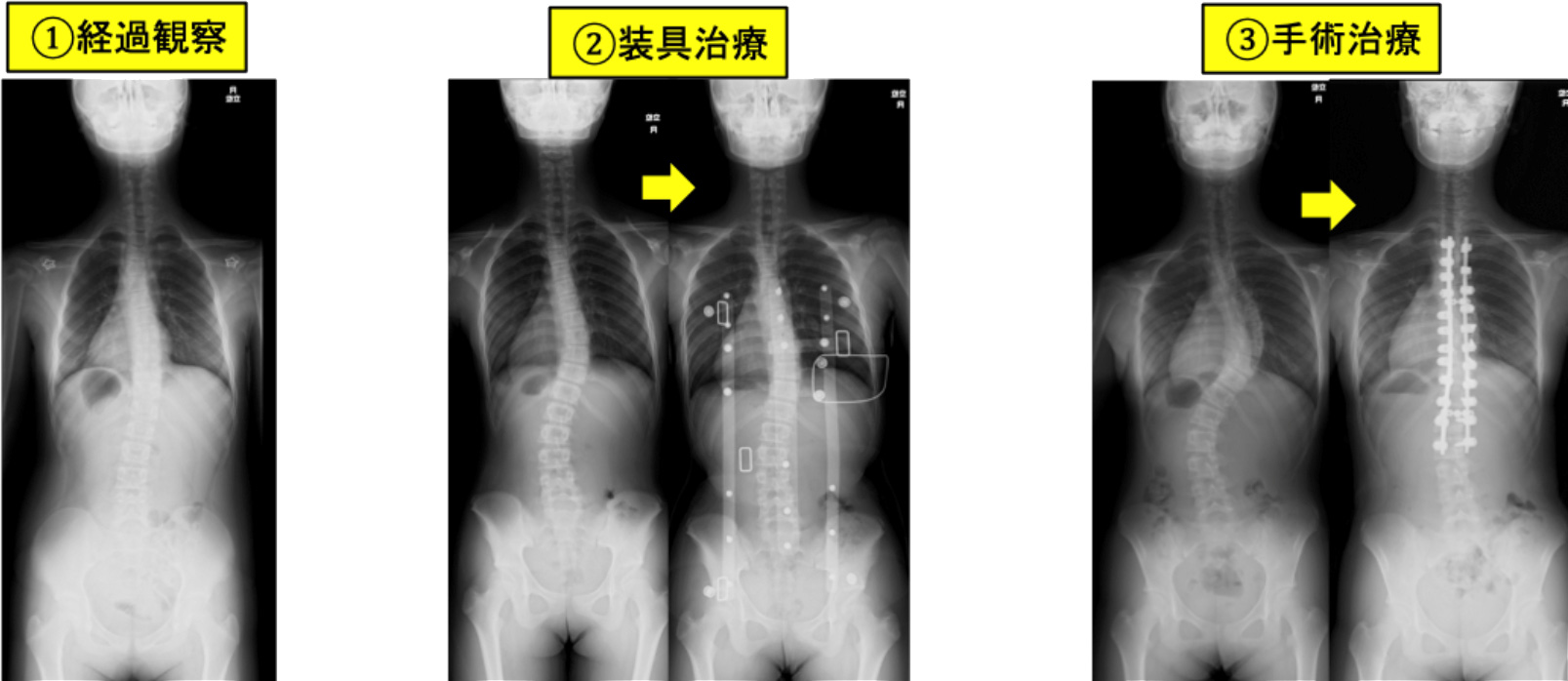 小児側弯症