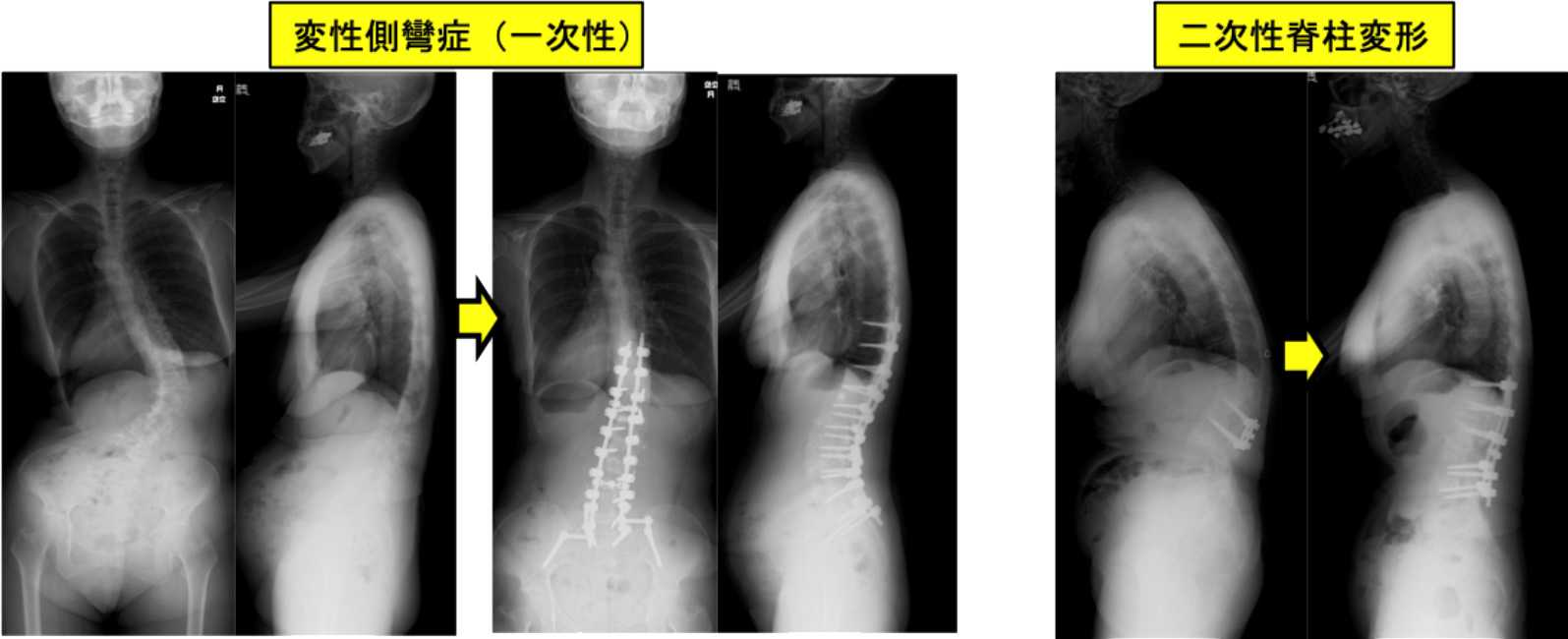 成人脊柱変形