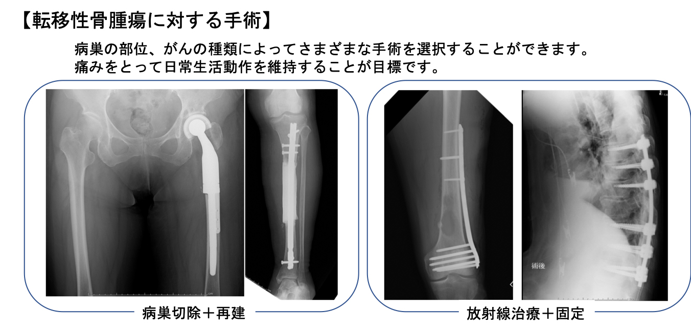 転移性骨腫瘍に対する手術